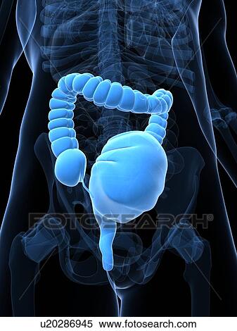 Stock Illustration - Toxic megacolon, artwork. Fotosearch