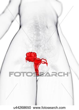 Uterine cancer, artwork View Large Illustration Clipart - Uterine cancer, artwork. Fotosearch