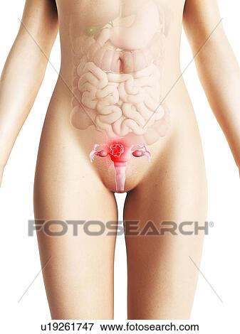 Uterine cancer, artwork View Large Illustration Stock Illustration - Uterine cancer, artwork. Fotosearch
