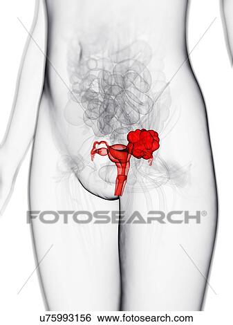 Uterine cancer, artwork View Large Illustration Stock Illustration - Uterine cancer, artwork. Fotosearch