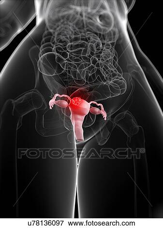 Uterine cancer, artwork View Large Illustration Stock Illustration - Uterine cancer, artwork. Fotosearch
