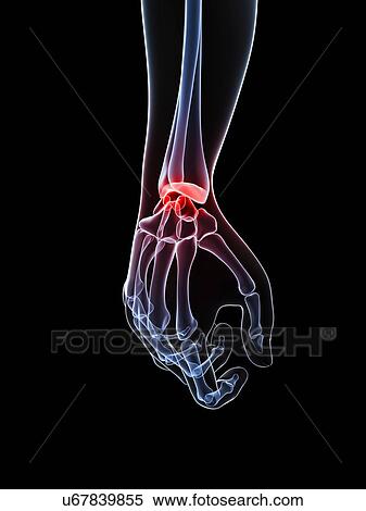 Wrist pain, conceptual artwork View Large Illustration Stock Illustration - Wrist pain, conceptual artwork. Fotosearch