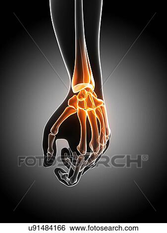 Stock Illustration - Wrist pain, conceptual artwork. Fotosearch