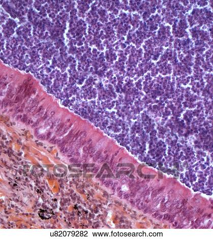Drawing - Acute bronchitis, light micrograph. Fotosearch
