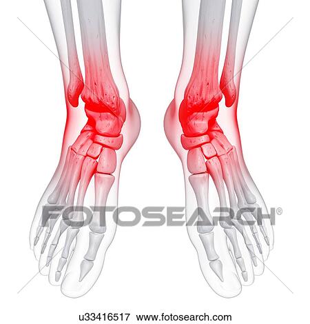 Ankle pain, artwork View Large Illustration Stock Illustration - Ankle pain, artwork. Fotosearch