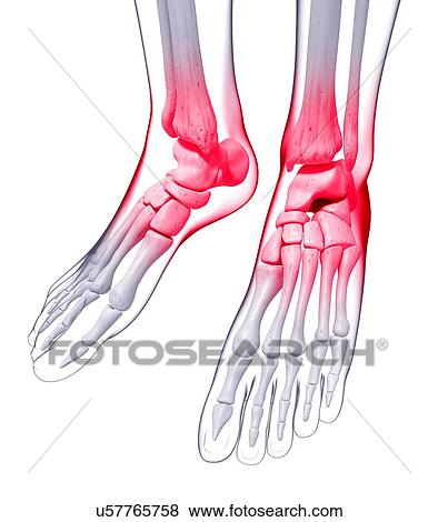 Ankle pain, artwork View Large Illustration Stock Illustration - Ankle pain, artwork. Fotosearch