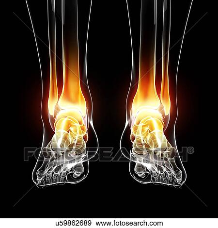 Stock Illustration - Ankle pain, artwork. Fotosearch