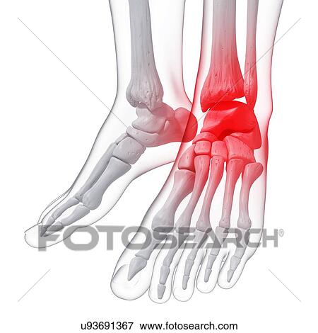 Ankle pain, artwork View Large Illustration Stock Illustration - Ankle pain, artwork. Fotosearch