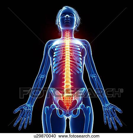 Clipart - Back pain, artwork. Fotosearch