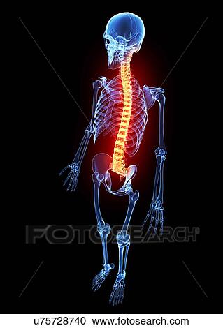Clipart - Back pain, artwork. Fotosearch