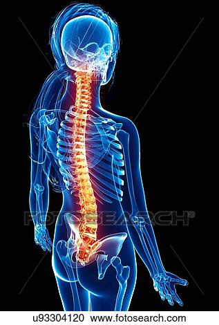 Clipart - Back pain, artwork. Fotosearch