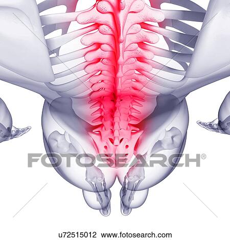 Back pain, artwork View Large Illustration Drawing - Back pain, artwork. Fotosearch