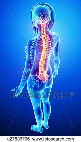 Stock Illustration - Back pain, artwork. Fotosearch