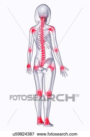 Stock Illustration - Back pain, artwork. Fotosearch