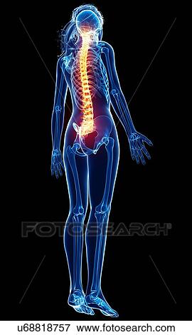 Stock Illustration - Back pain, artwork. Fotosearch