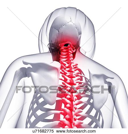 Stock Illustration - Back pain, artwork. Fotosearch