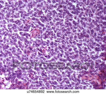 Drawing - Bone cancer, light micrograph. Fotosearch