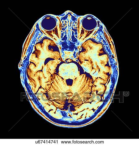 Clip Art - Coloured MRI scan of the human head. Fotosearch