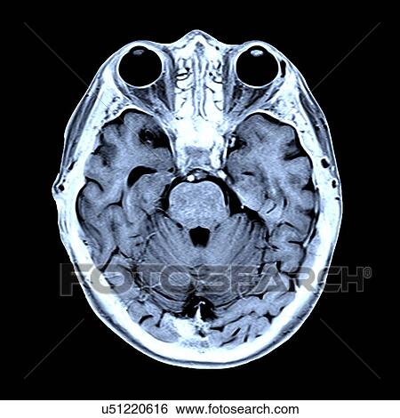 Stock Illustration - Coloured MRI scan of the human head. Fotosearch