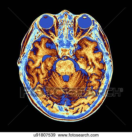 Stock Illustration - Coloured MRI scan of the human head. Fotosearch