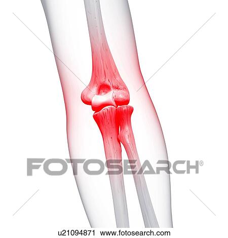 Clip Art - Elbow pain, artwork. Fotosearch