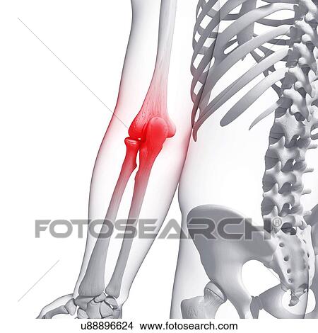 Stock Illustration - Elbow pain, artwork. Fotosearch