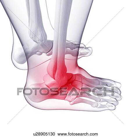 Foot pain, artwork View Large Illustration Clipart - Foot pain, artwork. Fotosearch