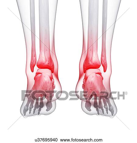 Clipart - Foot pain, artwork. Fotosearch