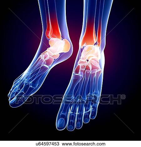 Foot pain, artwork View Large Illustration Drawing - Foot pain, artwork. Fotosearch