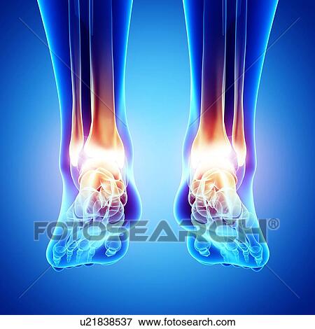 Foot pain, artwork View Large Illustration Stock Illustration - Foot pain, artwork. Fotosearch