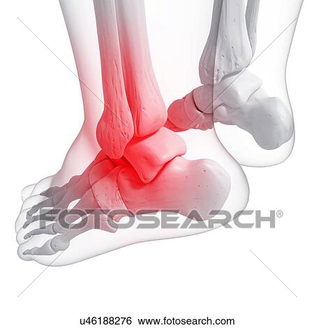 Stock Illustration - Foot pain, artwork. Fotosearch