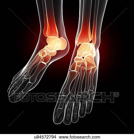 Foot pain, artwork View Large Illustration Stock Illustration - Foot pain, artwork. Fotosearch