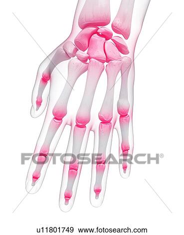 Stock Illustration - Hand pain, artwork. Fotosearch
