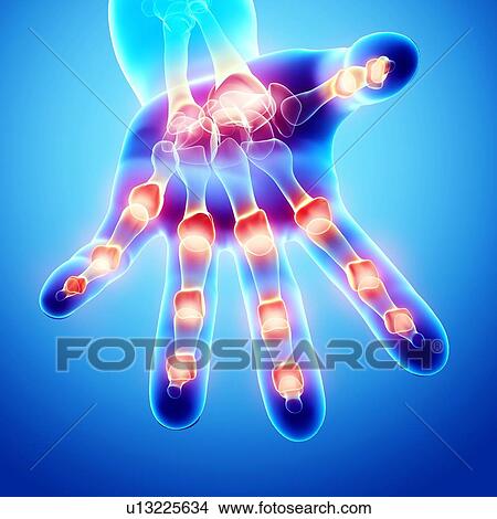 Stock Illustration - Hand pain, artwork. Fotosearch