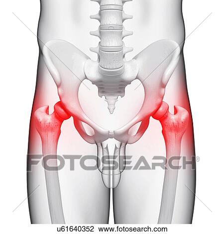 Drawing - Hip pain, artwork. Fotosearch