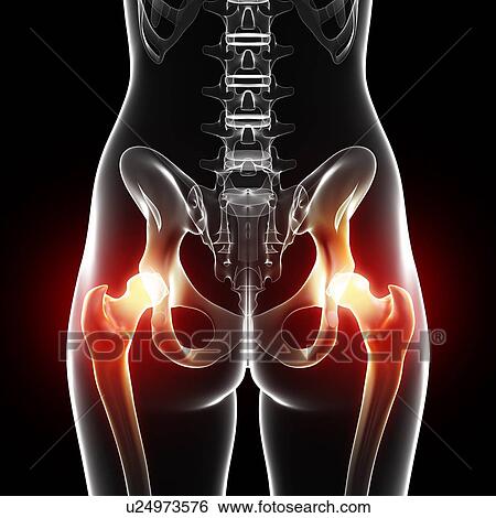 Stock Illustration - Hip pain, artwork. Fotosearch