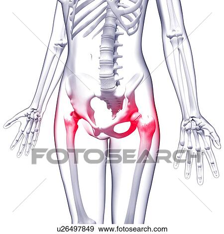 Hip pain, artwork View Large Illustration Stock Illustration - Hip pain, artwork. Fotosearch