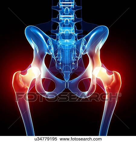 Stock Illustration - Hip pain, artwork. Fotosearch