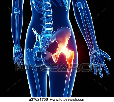 Stock Illustration - Hip pain, artwork. Fotosearch