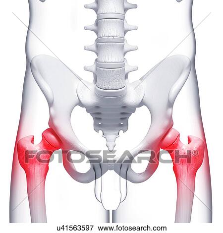 Hip pain, artwork View Large Illustration Stock Illustration - Hip pain, artwork. Fotosearch