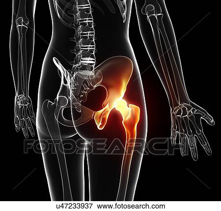 Stock Illustration - Hip pain, artwork. Fotosearch