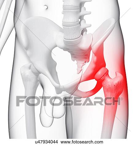 Hip pain, artwork View Large Illustration Stock Illustration - Hip pain, artwork. Fotosearch