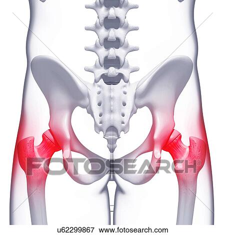 Hip pain, artwork View Large Illustration Stock Illustration - Hip pain, artwork. Fotosearch