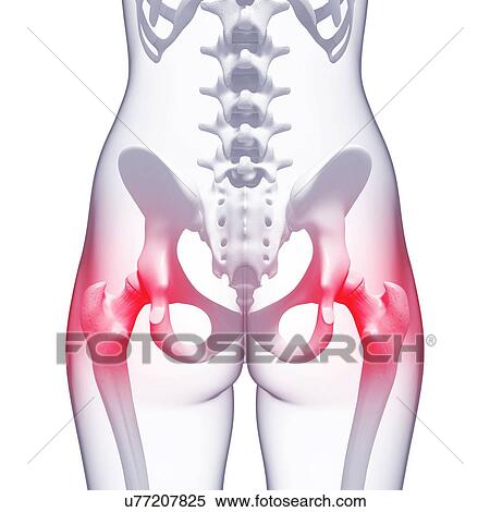 Stock Illustration - Hip pain, artwork. Fotosearch
