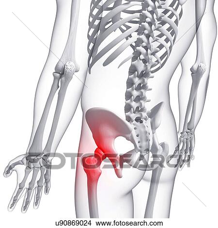 Hip pain, artwork View Large Illustration Stock Illustration - Hip pain, artwork. Fotosearch