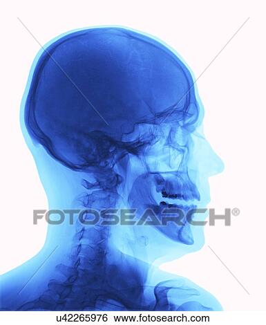 Stock Illustration - Human head, x-ray. Fotosearch