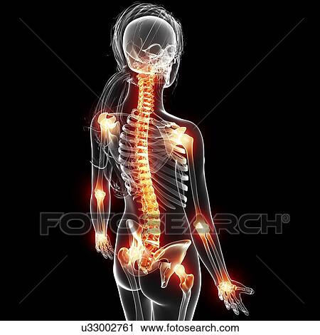 Clip Art - Joint pain, artwork. Fotosearch