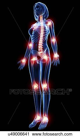 Clip Art - Joint pain, artwork. Fotosearch