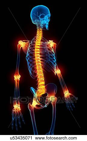 Clip Art - Joint pain, artwork. Fotosearch