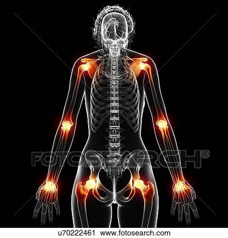 Clip Art - Joint pain, artwork. Fotosearch